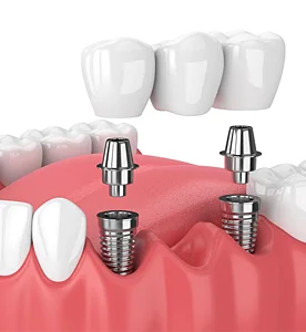 Porcelain Dental Bridges explanation