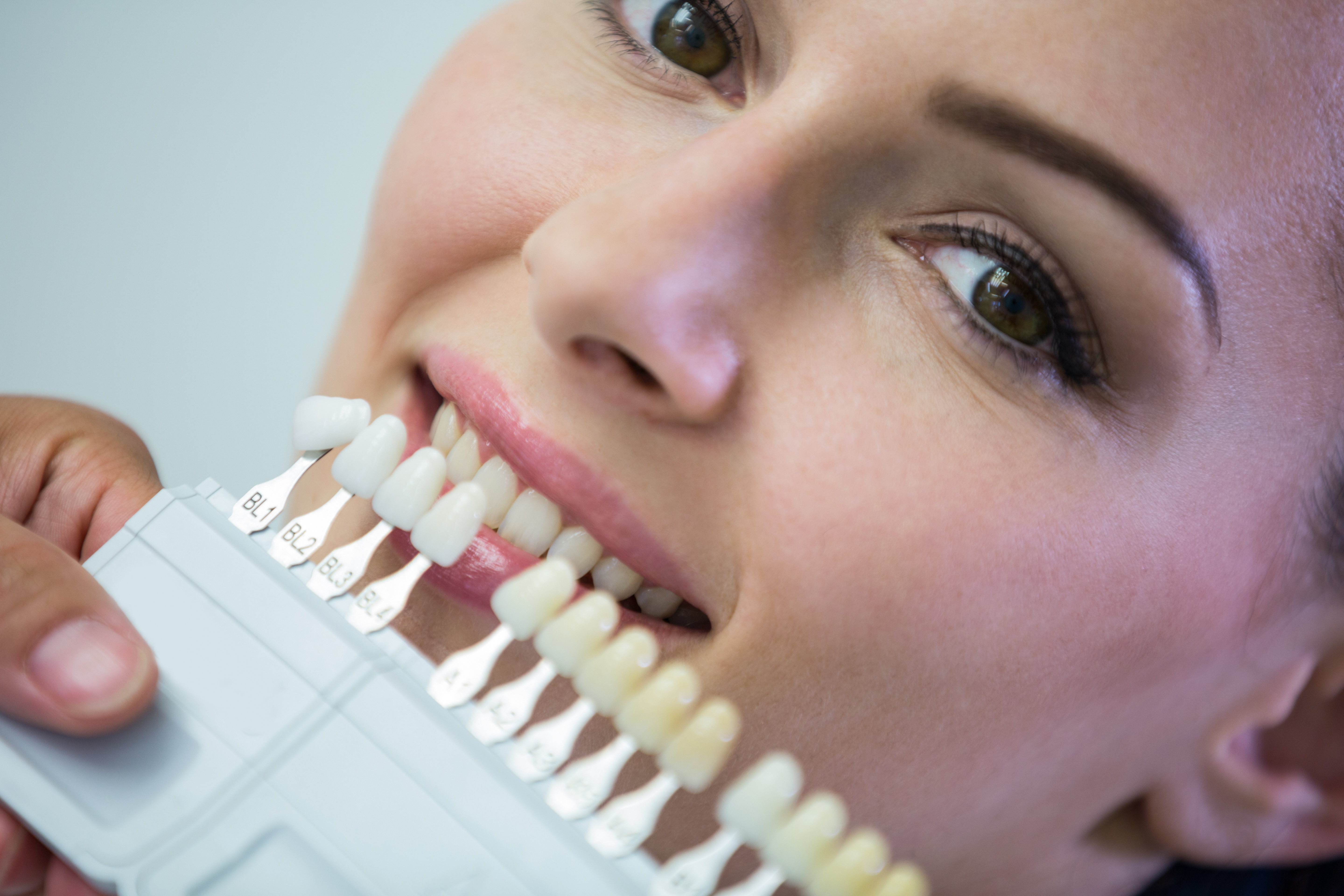 Porcelain Veneers explanation