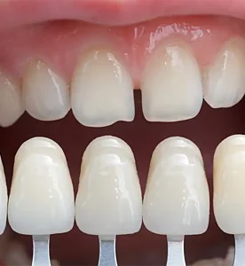 Porcelain Veneers explanation